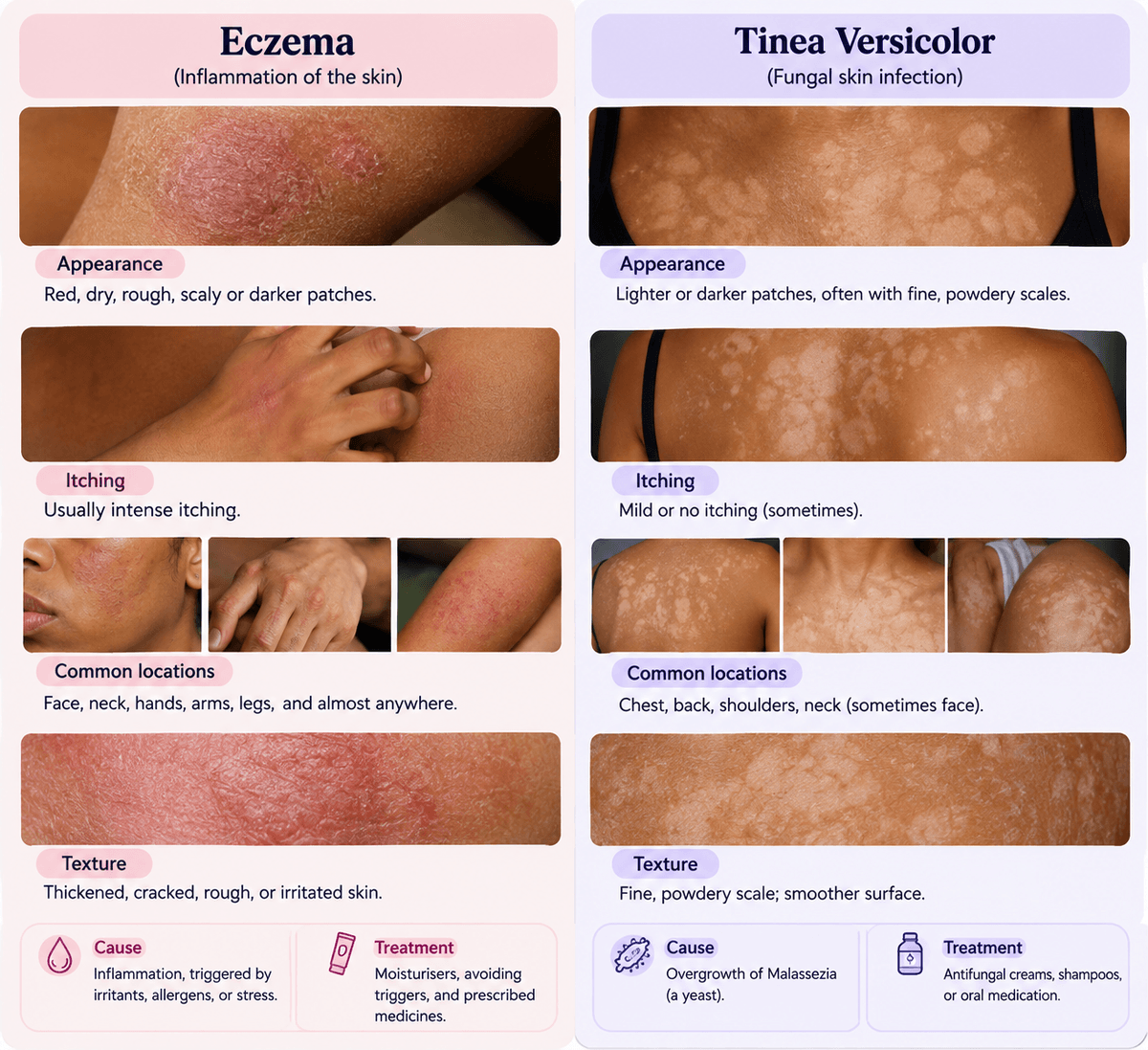 Eczema vs. Tinea Versicolor: How to Know the Difference